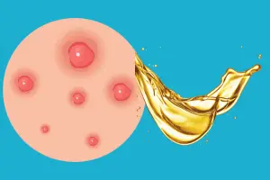 rosehip oil acne